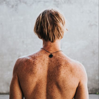 A man's back is covered in moles and freckles