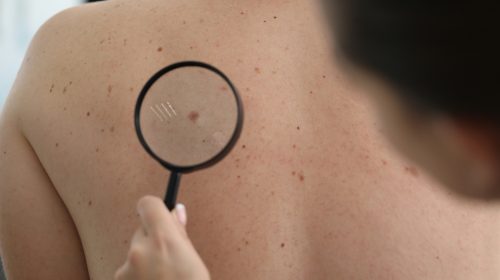 skin checks - melanoma screening mandurah