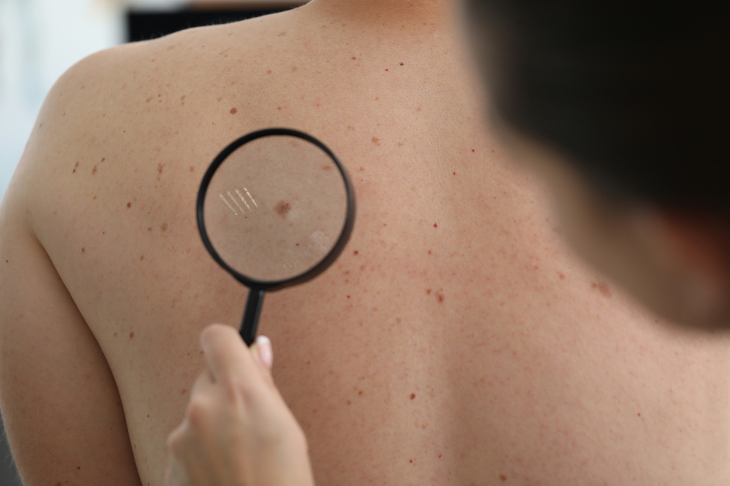 skin checks - melanoma screening mandurah